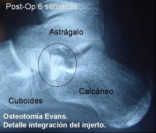 Pie plano infantil Caso Clínico