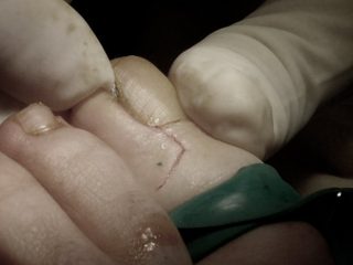Cirugía Metatarsal