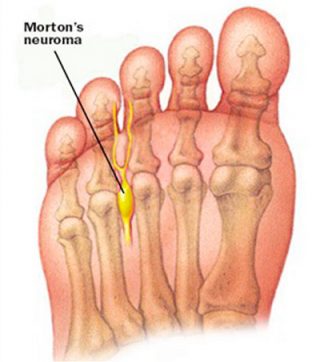 Neuroma de Morton