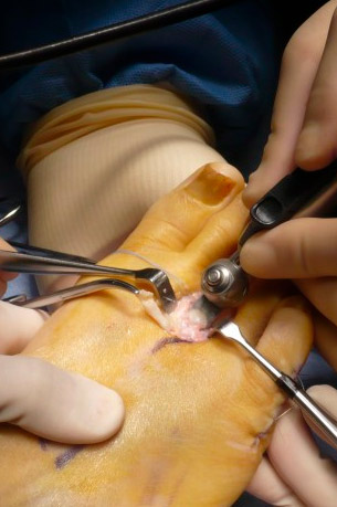 osteotomia weil operacion