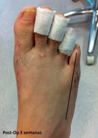 Post operatorio Juanete de Sastre