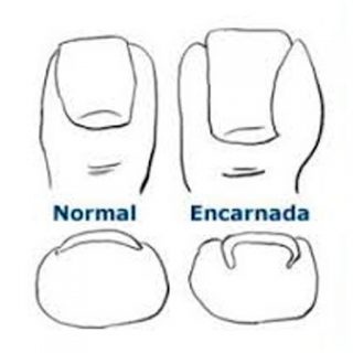 Uñas encarnadas